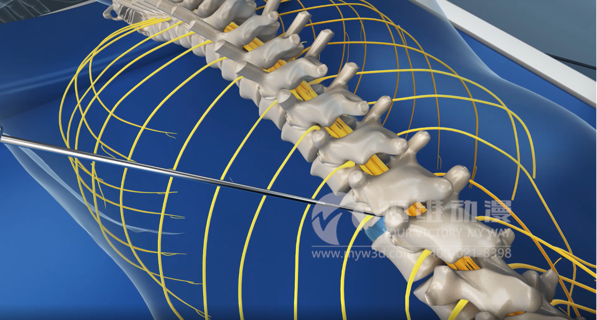 医学三维动画：三维手术模拟动画(图1)