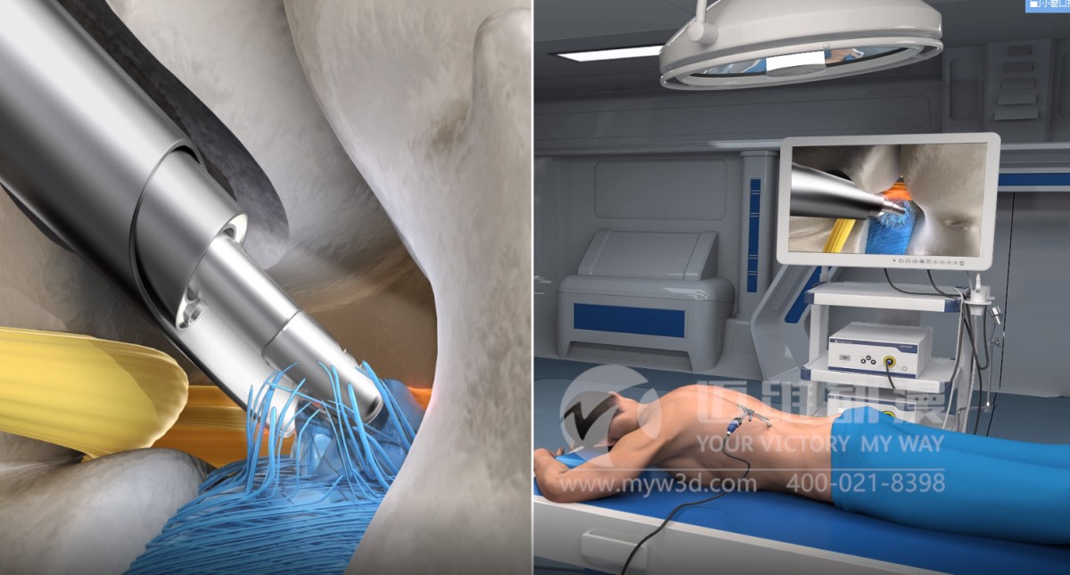 医学三维动画：三维手术模拟动画(图2)