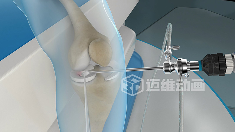 医疗器械-关节镜三维动画 医疗器械-关节镜三维演示效果图